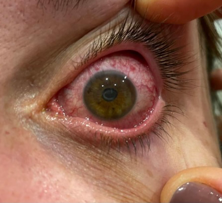 Causas de la Uveítis