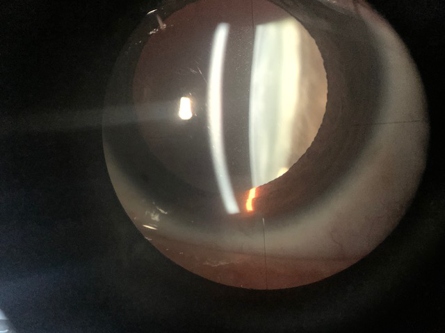 Complicaciones asociadas a la uveítis