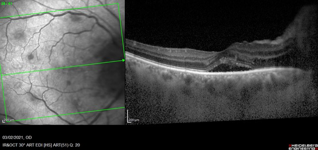 Estudios en pacientes con uveítis / escleritis