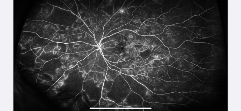 Estudios en pacientes con uveítis / escleritis