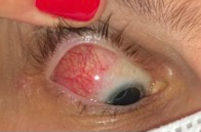 ¿Qué causa la escleritis?