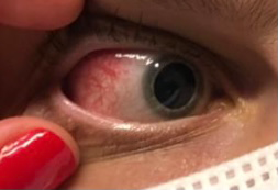 ¿Qué es la escleritis?