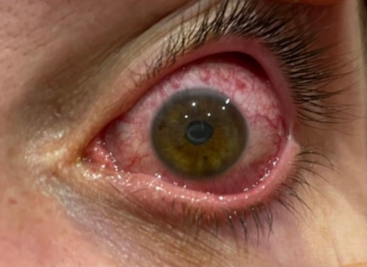 ¿Qué es la uveítis?